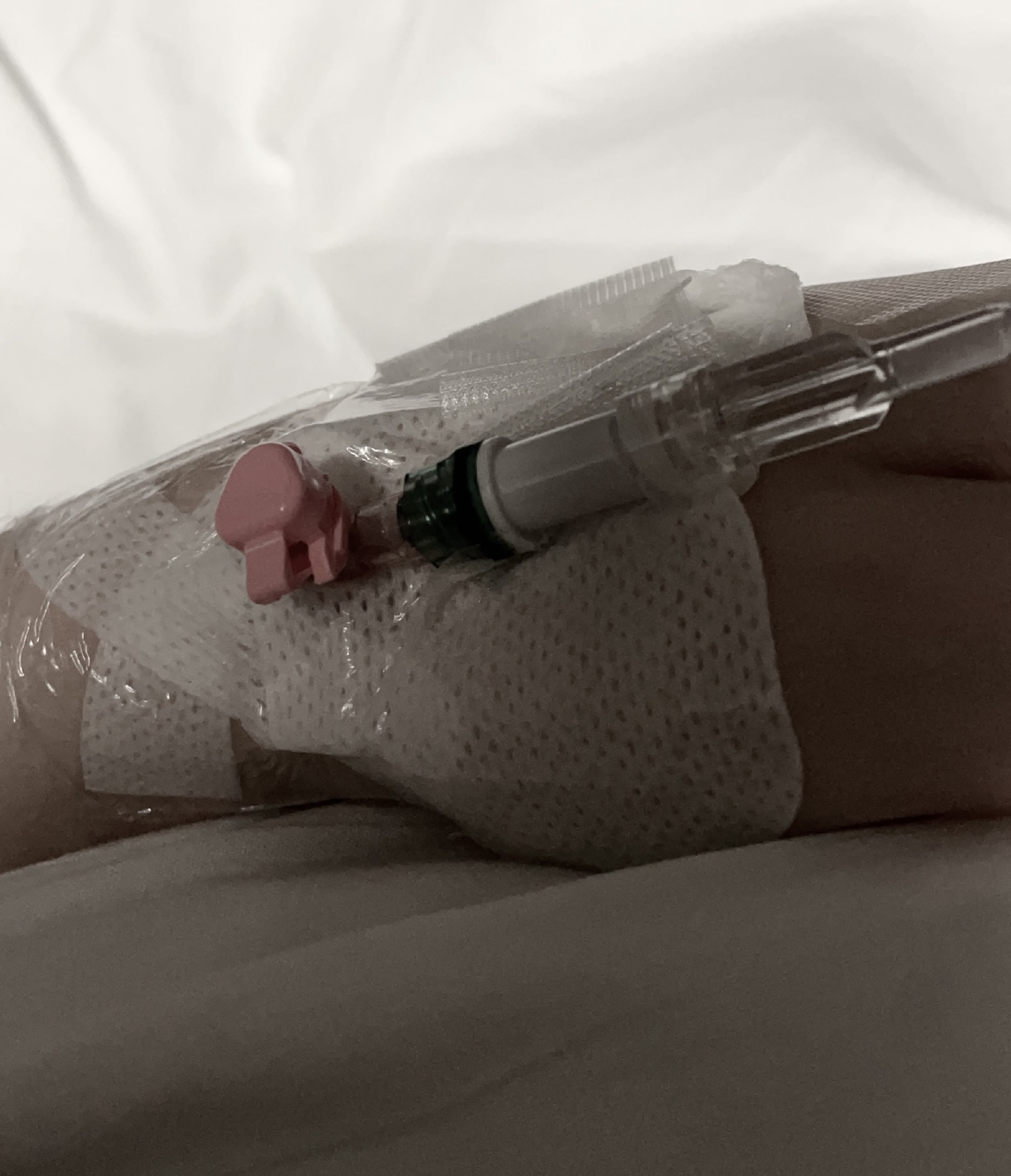 A cannula inserted into the hand during a laparoscopy